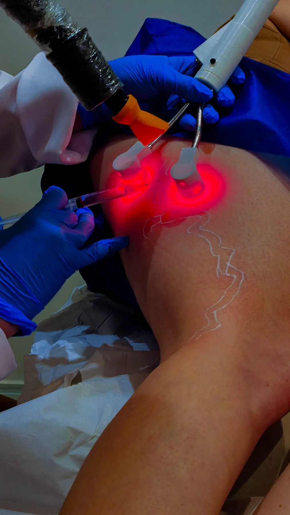 Detalhe de procedimento vascular na clínica